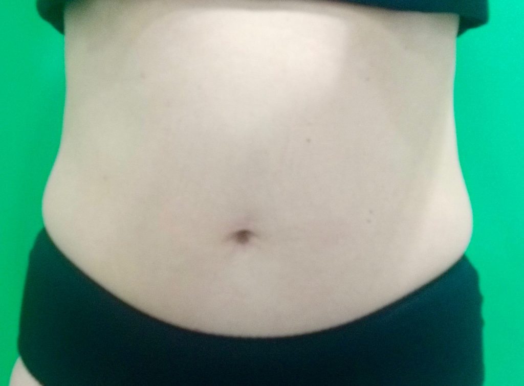 Coolsculpting progress update