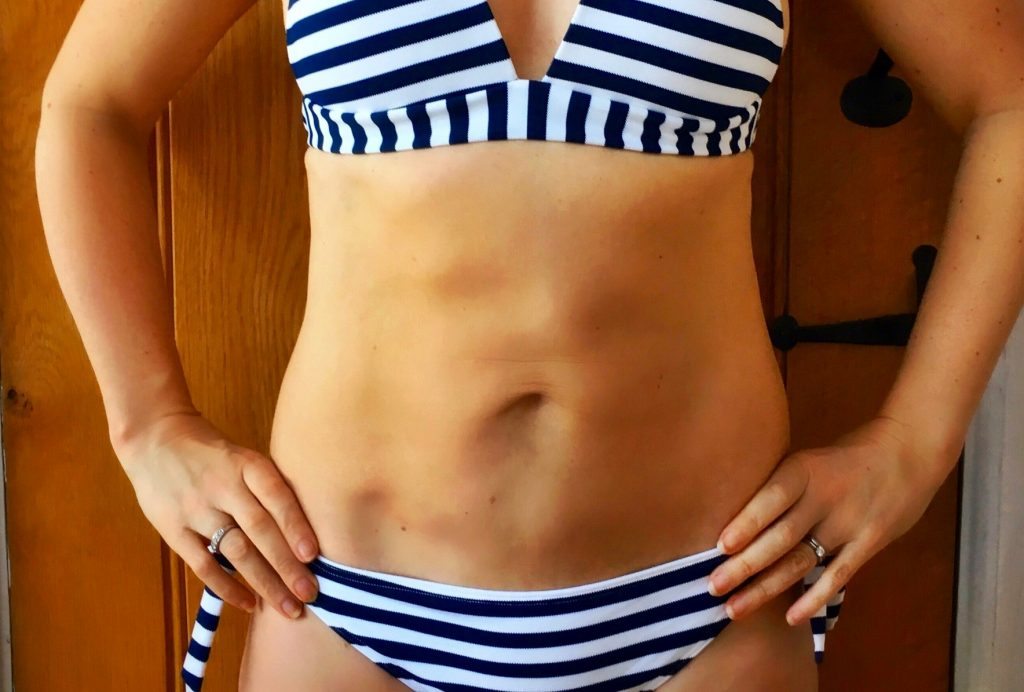 Coolsculpting progress update