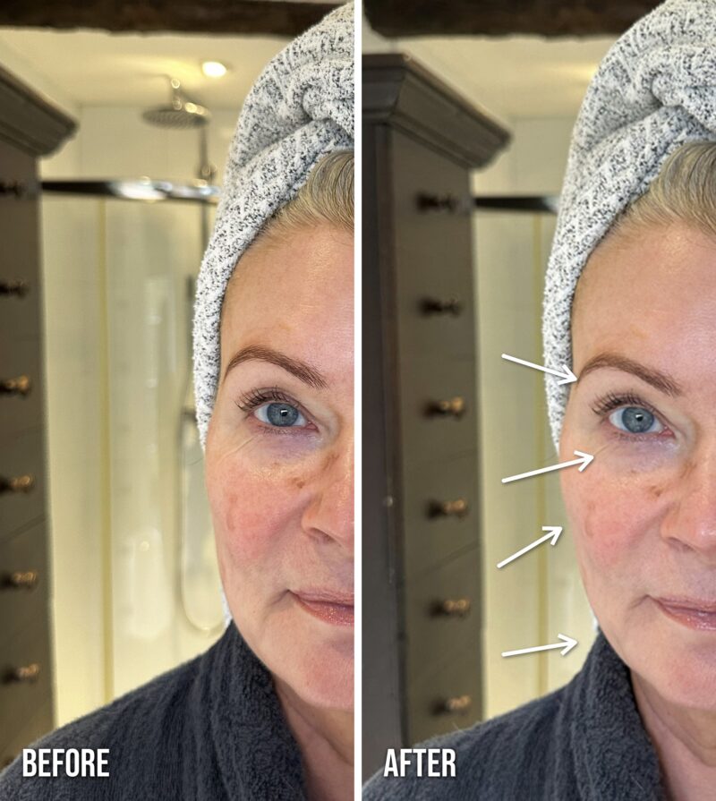ZIIP Halo before and after Instant Lift, same side of the face