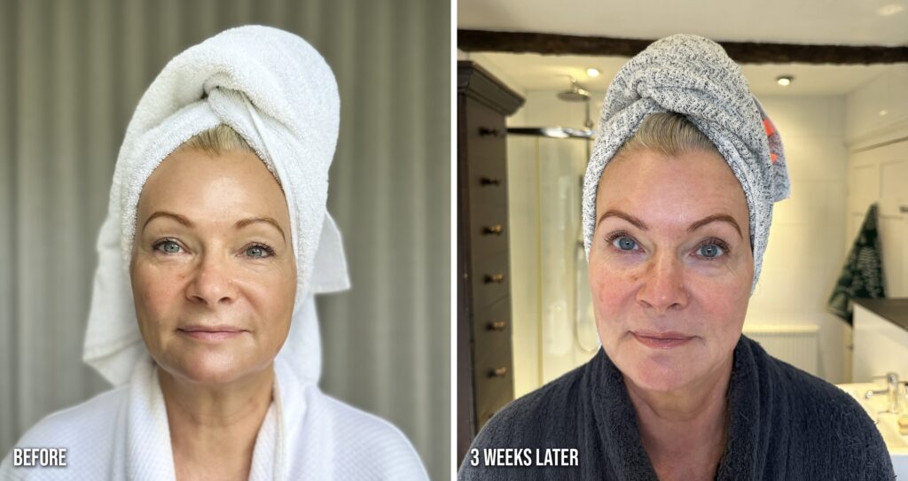 ZIIP Halo before and three weeks later, front