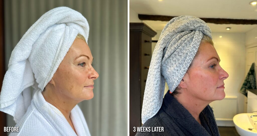 ZIIP Halo before and three weeks later, side profile