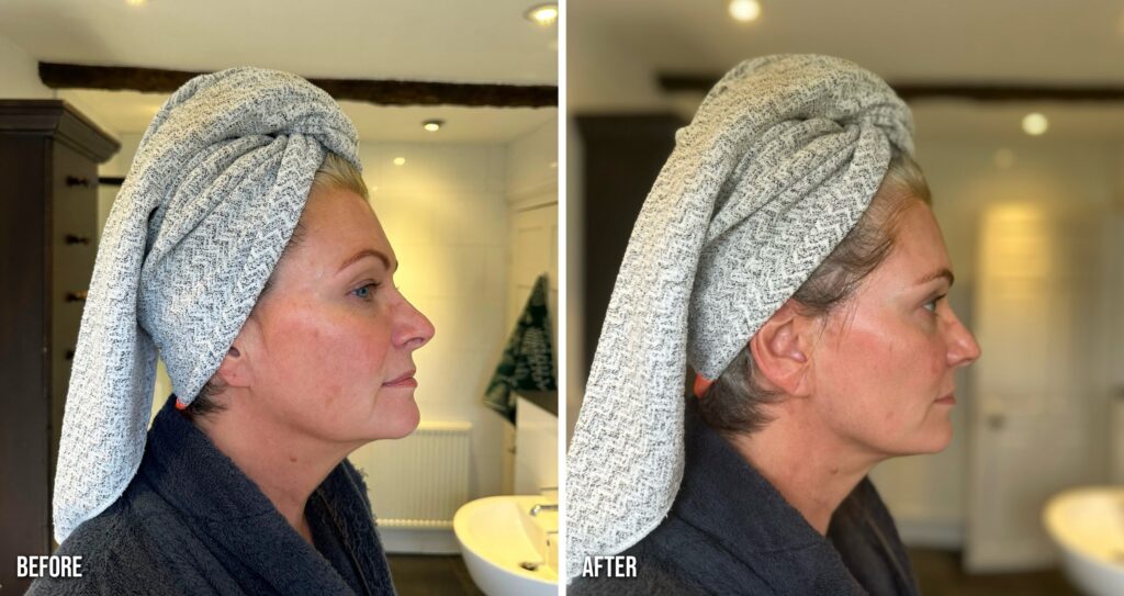 ZIIP Halo before and after Instant Lift, side profile